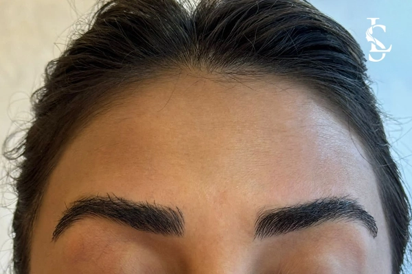 forehead-botox-after-01