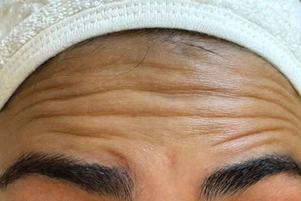 forehead-botox-before-01