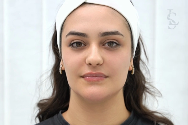 full-face-filler-after-01