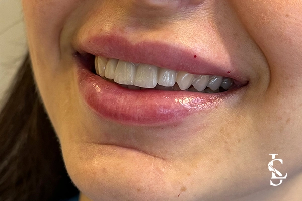 lip-filler-after-01
