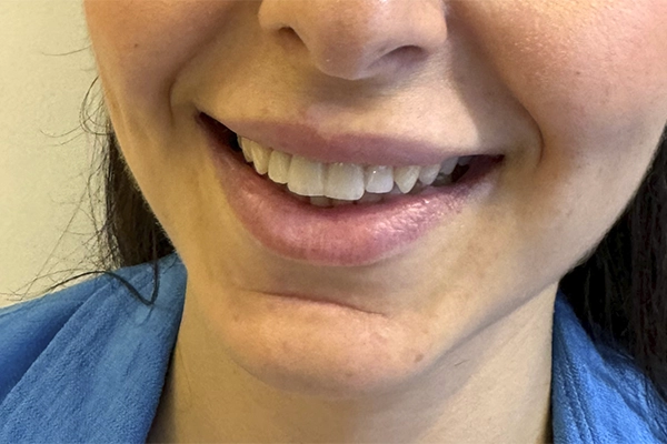 lip-filler-before-01