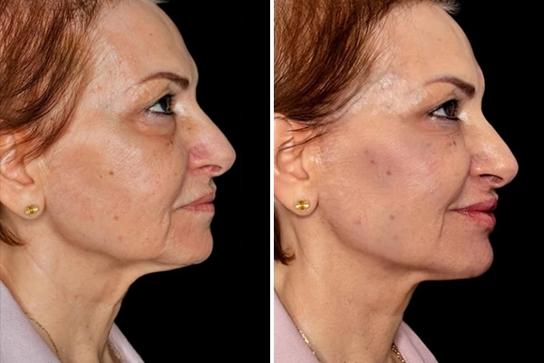 Full-face glow up
From lips and jawline to cheeks, temples, and under-eyes, every detail was carefully treated.