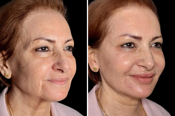 Full-face glow up
From lips and jawline to cheeks, temples, and under-eyes, every detail was carefully treated.