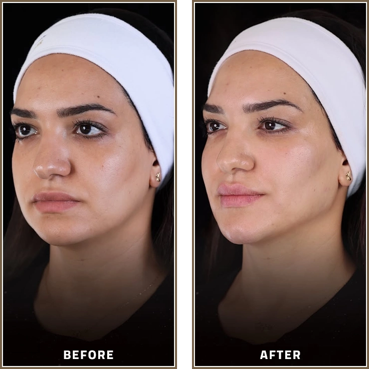 Face lifting enhances facial balance and definition, highlighting natural features with refined and harmonious results.