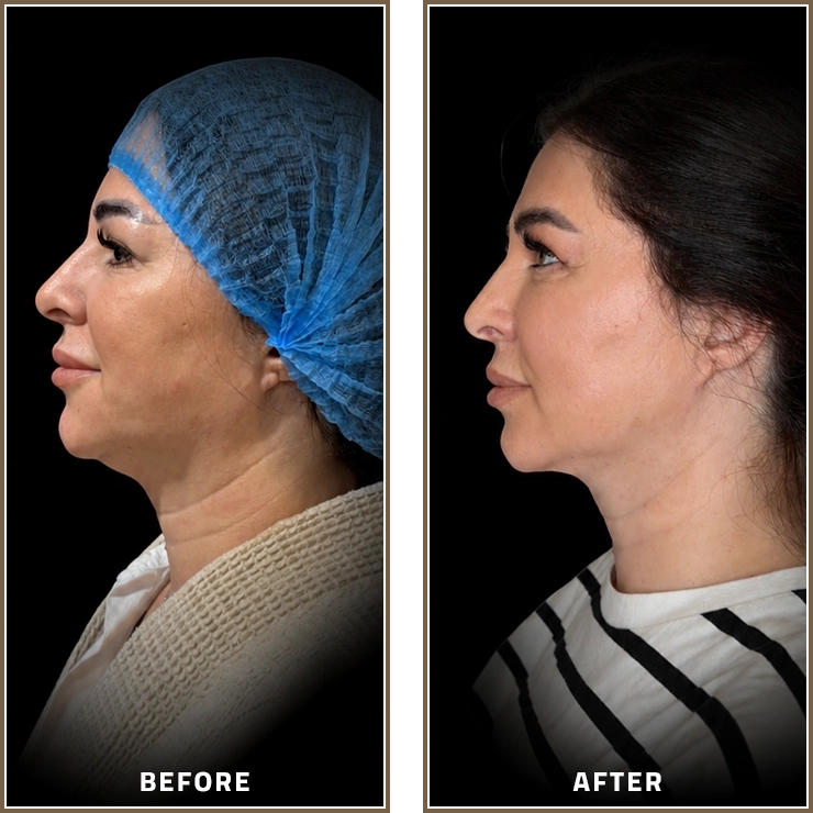 Face Tightening and Rejuvenation