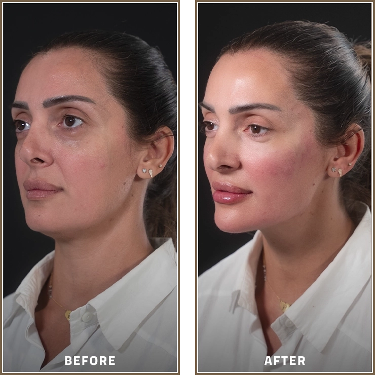 Full Face Contouring and Profile Enhancement
