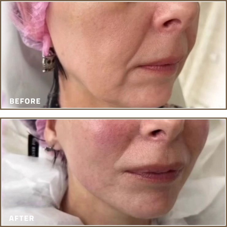 Karisma Skin Booster Before and After for Improved Skin Radiance