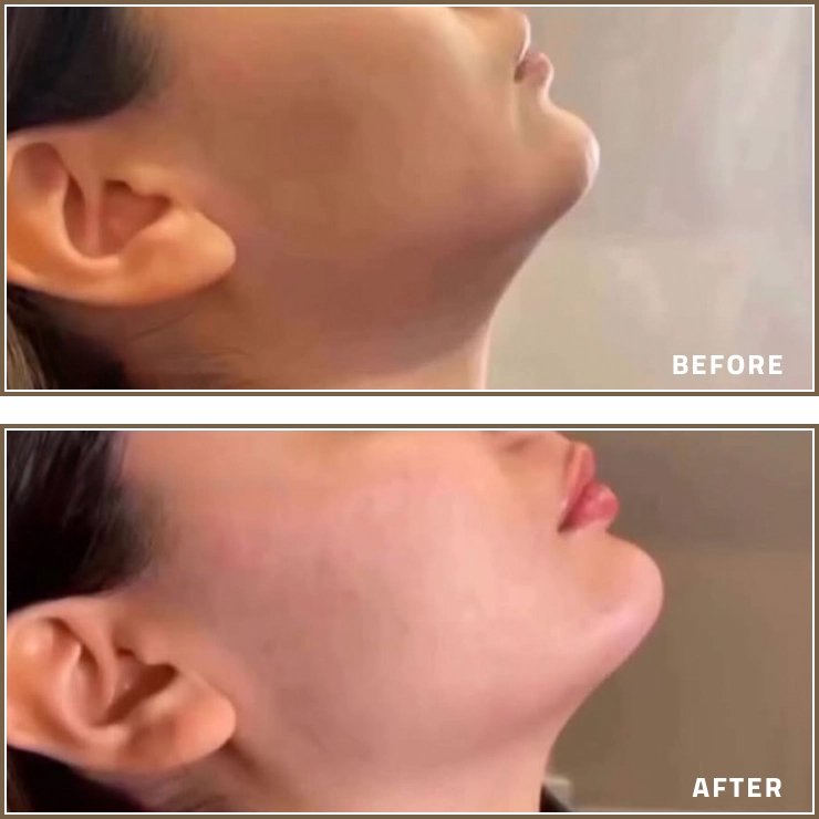 Lip Filler and Chin Enhancement Before and After Results