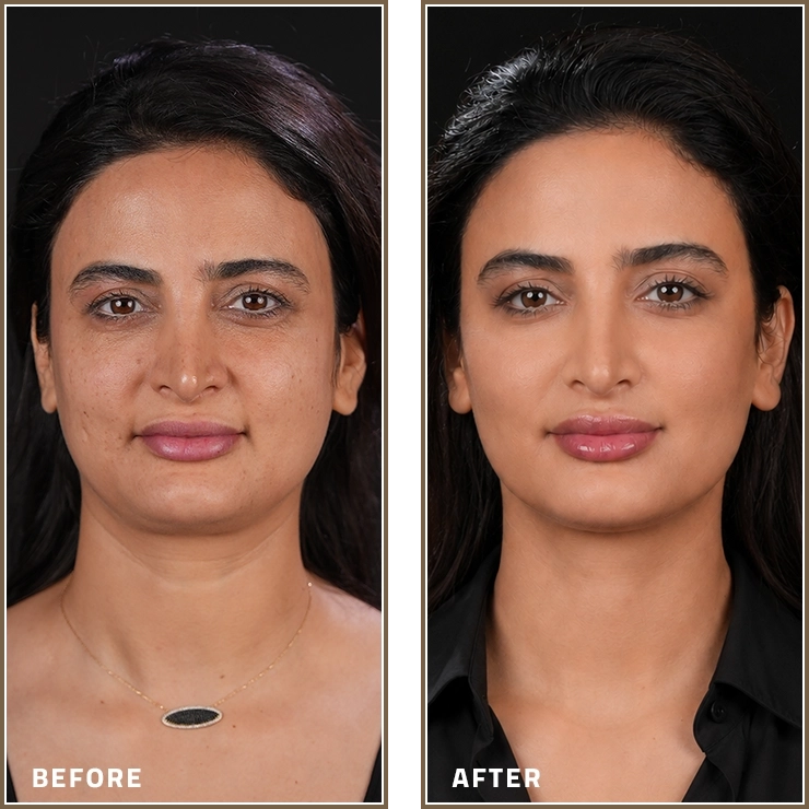 Skin Booster
